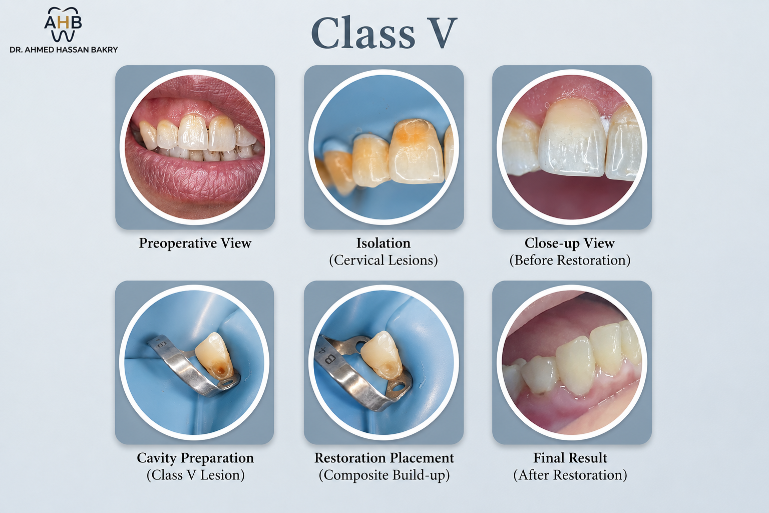Class V